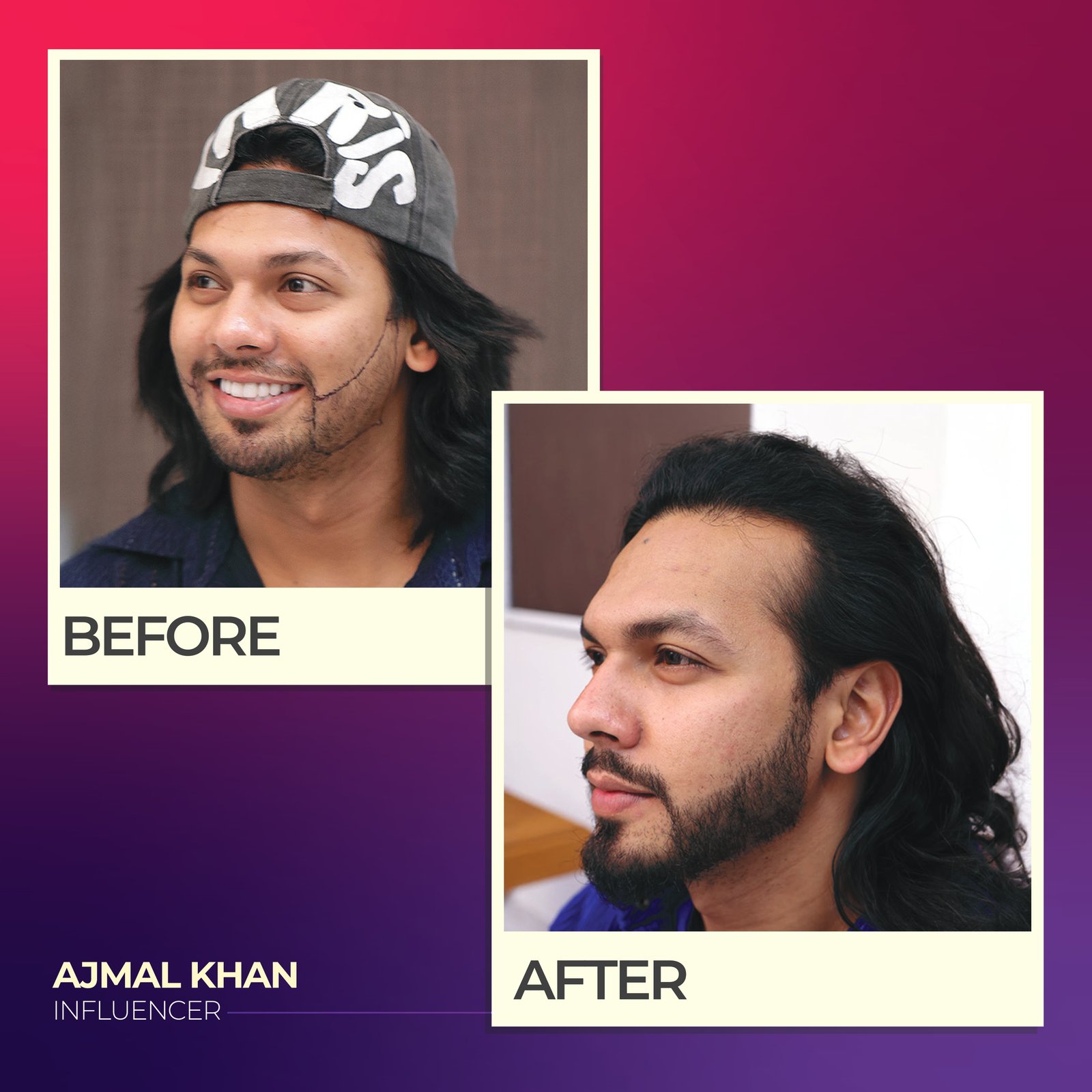 Beard Hair Transplant